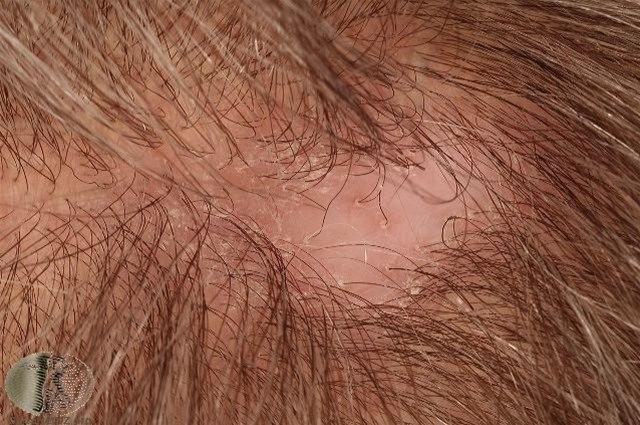 Fotoet viser lokalisert alopeci