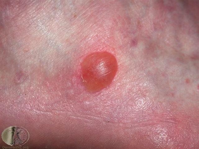 Fotoet viser blemme, friksjon (gnagsår).jpg