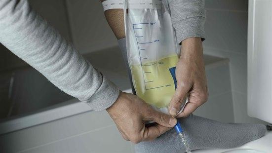 Illustrasjonsfoto som viser en halvfull urinpose fra et kateter, som er festet på venstre leggen til en mann. Foten står på randen av en toalettskål, og mannen åpner ventilen med begge hender, slik at urinen renner ut i toalettet. 