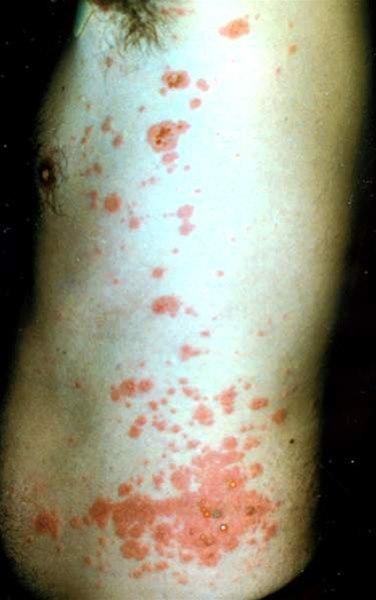 Utslett med blemmer av varierende størrelse på erythematøs hud.