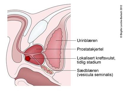 Illustrasjonen viser et lengdesnitt gjennom underlivet av en mann med lokalisert prostatakreft. Bildet er fargelagt. Svulsten, prostataen, urin- og sædblæren er merket med streker og tekst.