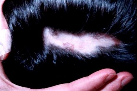 Alopecia areata