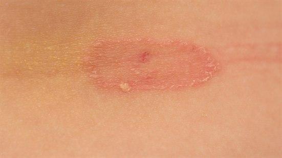 "Ringorm" Dermatofyttinfeksjon/ring på hud. 