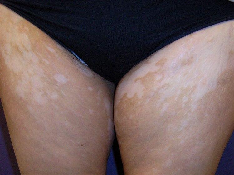 Vitiligo