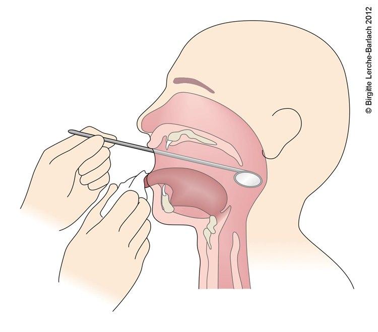 Speilundersøkelse av nedre del av svelget.