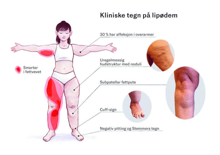 Illustrasjon av kvinne som viser kliniske tegn på lipødem (karakteristisk fettfordeling)