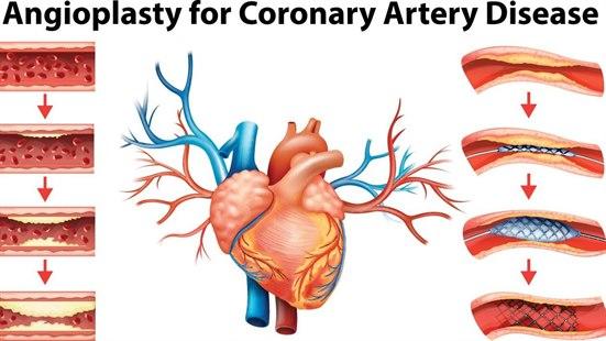Angioplasty