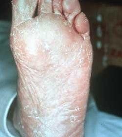 Fotsopp, mokkasintype