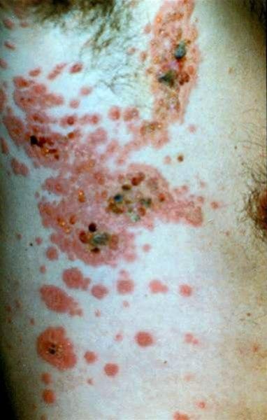 Blemmer av varierende størrelse på erythematøs hud.