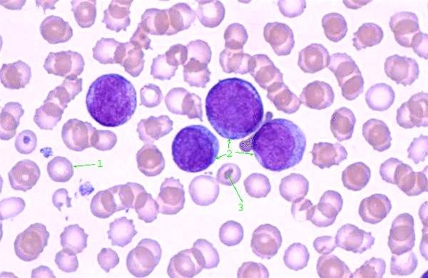 Illustrasjon: Umodne blodceller typisk ved blodkreft