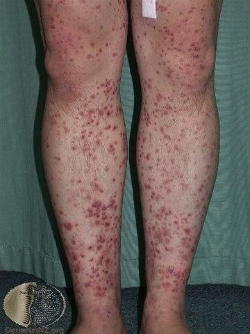 Fotoet viser vaskulitt på legger