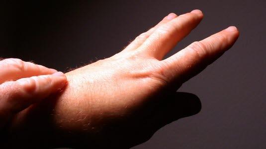 Rheumatoid arthritis hand
