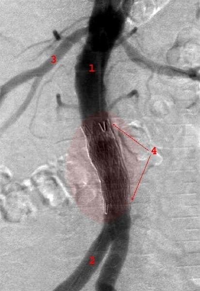 Aorta stentgraft