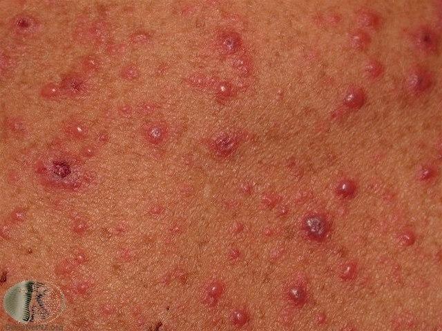 Fotoet viser nærbilde av vannkopper