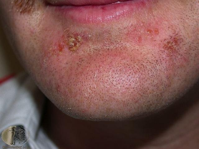 Fotoet viser brennkopper