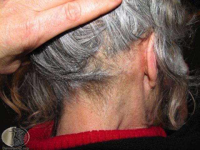 Fotoet viser seboreisk eksem i hodebunnen og bak øret