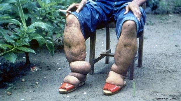 Lymphatic filariasis