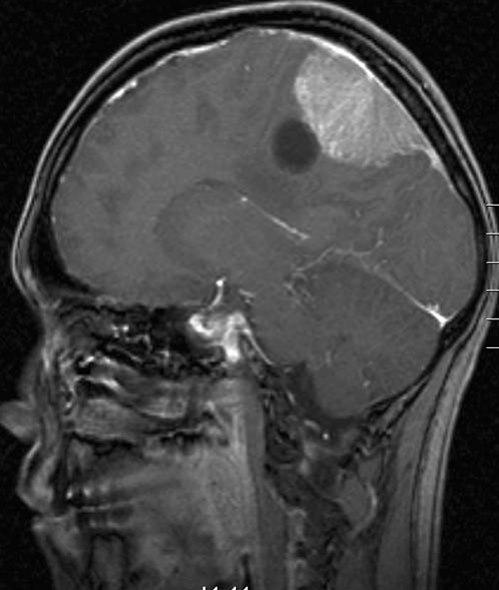meningiom med cyste 1