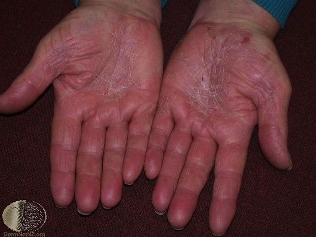 Fotoet viser kronisk dermatitt, hånd