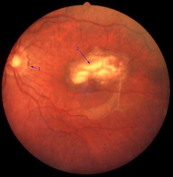 Senil makuladegenerasjon