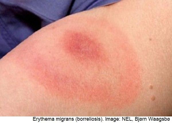 Erythema migrans
