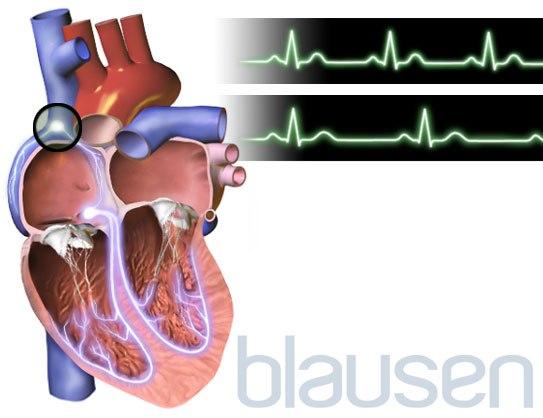 Bradykardi - langsom puls