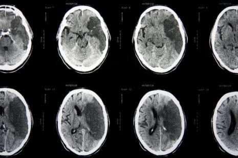 MRi showing expansive process