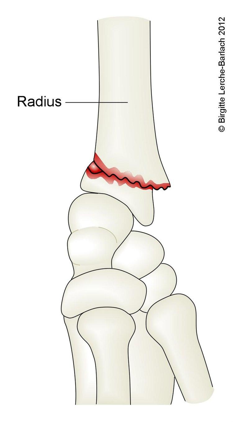 Håndleddsbrudd med forskyvning