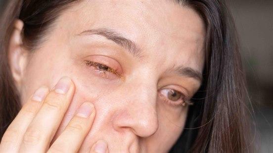 Fotoet viser den øvre delen av ansiktet til en kvinne med lys hud og mørkt hår. Hun tar på høyre kinnet med sin hånd. Hun har akutt øyekatarr i sitt høyre øye. 