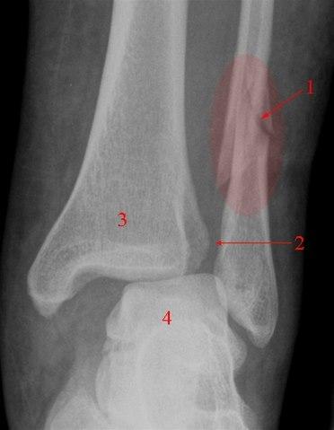 Ankelfraktur, ustabil