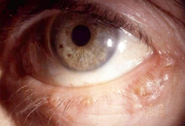 Bilde av basalcellecarcinom på nedre øyelokk