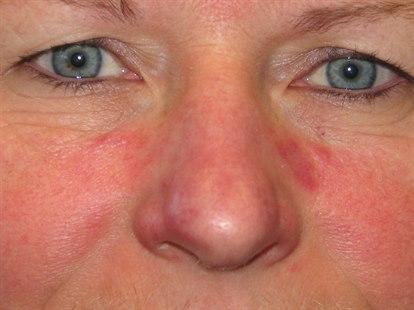 Foto viser et nærbilde av en kvinnes øyne, nese og kinnparti med hudforandringer (rødme) forenlig med rosacea.