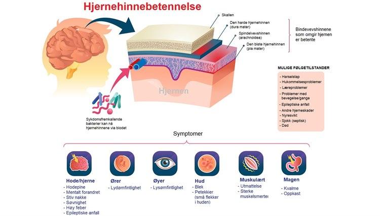 Hjernehinnebetennelse.jpg