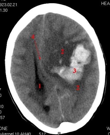 Cerebral blødning med overskyvning (CT)