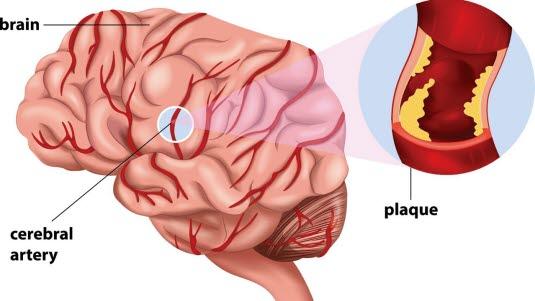 Nedsatt blodsirkulasjon i hjernen