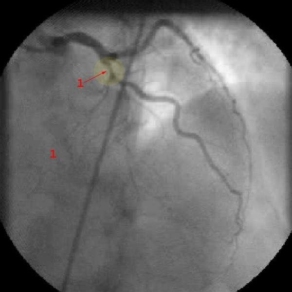 Stenose venstre koronararterie