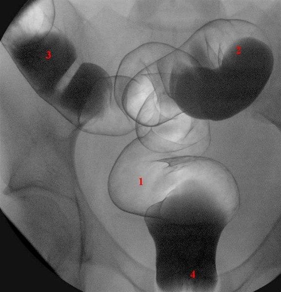Colon oversikt rektosigmoideum