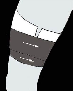 Låret, muskelskader, teiping bilde#6