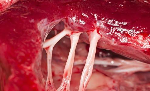 Hjerteklaff med tråder (chordae tendinae)