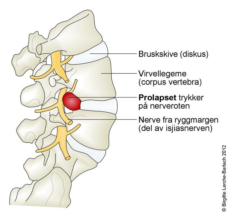 Lumbalt skiveprolaps sett fra siden