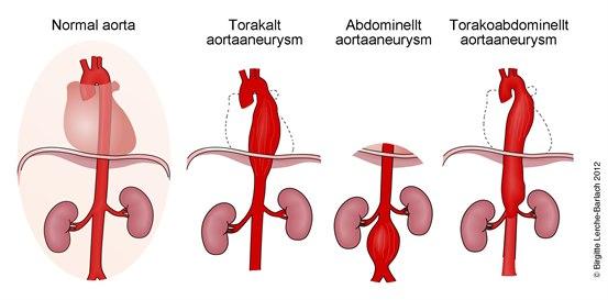 1550 Definition af aortaaneurismer.jpg