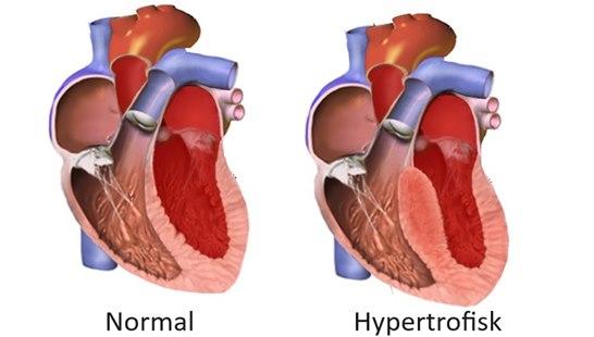Normalt hjerte og hjerte med hypertrofisk kariomyopati