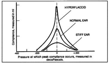 Tympanometri, bevegelighetsmønstre