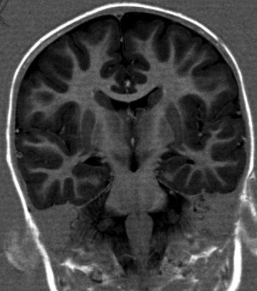 MS forandringer (MR koronarsnitt)