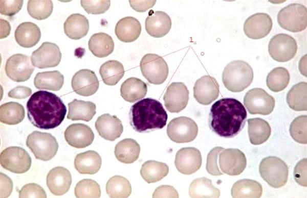 Kronisk lymfatisk leukemi (x 100)
