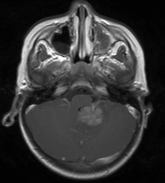 atypisk teratoid rhabdoid tumor 1