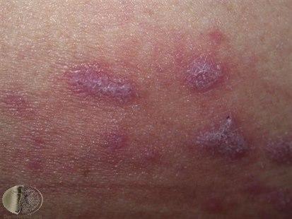 Fotoet viser hud som viser utslett forenelig med 3 typiske lichen planus lesjoner (fiolette flat-toppede papler og plakk med polygonale, retikulært mønster av hvite linjer på overflaten)