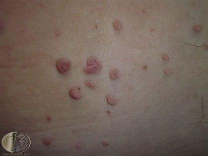 Fibroepithelial polyps (skin tags)