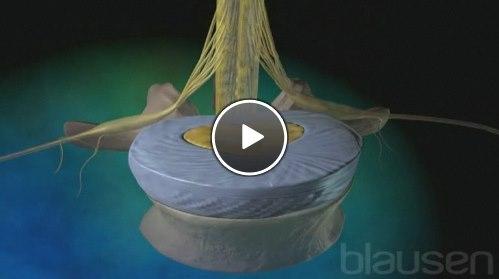 slitasje i mellomvirvelskivene