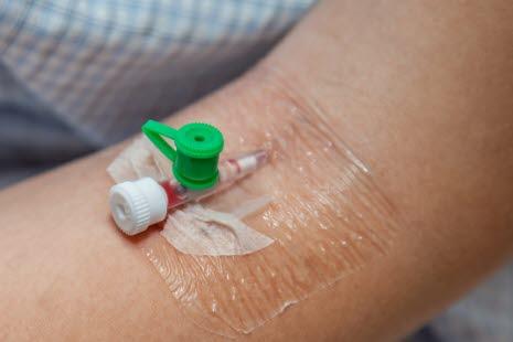 Venekanyle - disponerer for årebetennelse